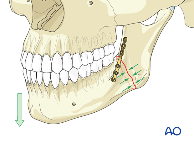 Load-sharing osteosynthesis allows the use of smaller plates (relative stability) due to the buttressing provided by the intact cortecies on either side of a simple fracture.