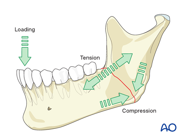Forces applied to the mandible cause varying tension and compression zones