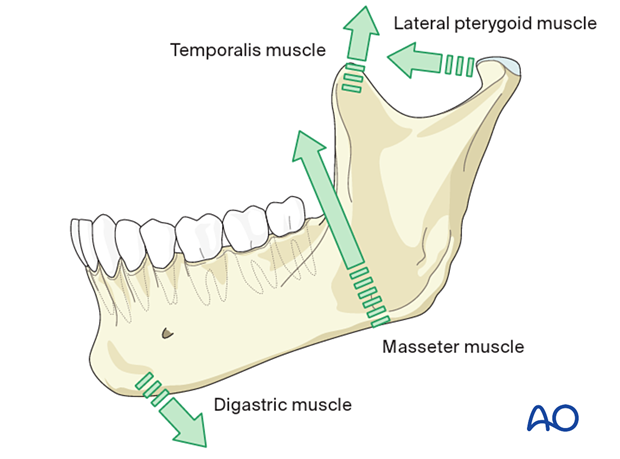 The mandible deforms with movement based on the origin and insertion of the muscles of mastication.