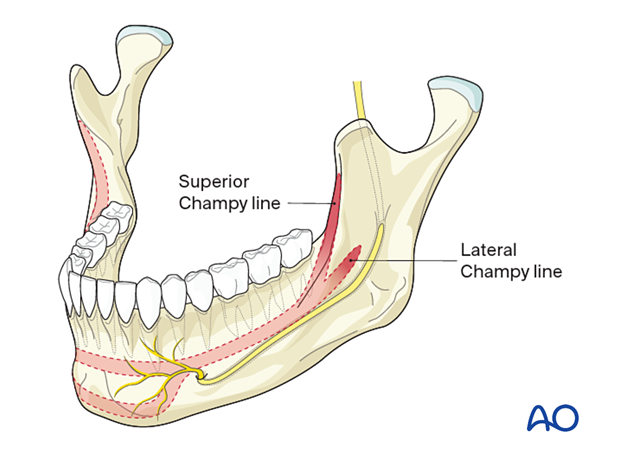 It is important to emphasize that there are two Champy lines in the mandibular angle