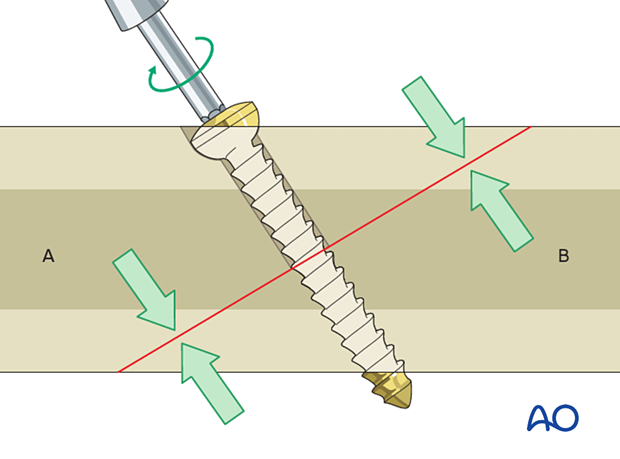 During screw tightening, the compressive effect occurs between the screw head on segment A and the threads at the far end of the screw in segment B