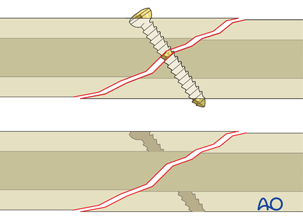 If the near cortex is not over drilled, the screw threads will engage in both the near and far cortices, preventing compression.