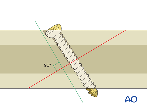 The axis of the screw should be as perpendicular as possible to the plane of the fracture