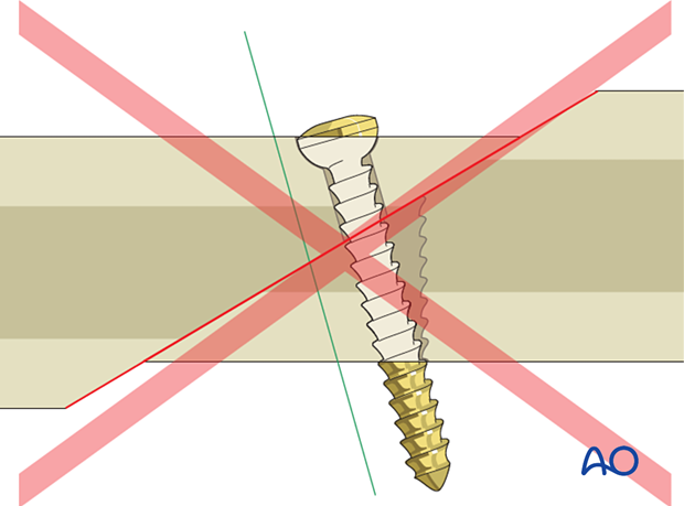 If the screw is far from perpendicular to the fracture plate, there will be a shearing force during screw tightening, which risks displacing the fracture