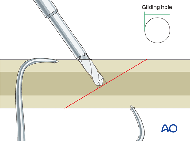 Drill the gliding hole in the near cortex using a drill bit with the same diameter as the threads of the screw.