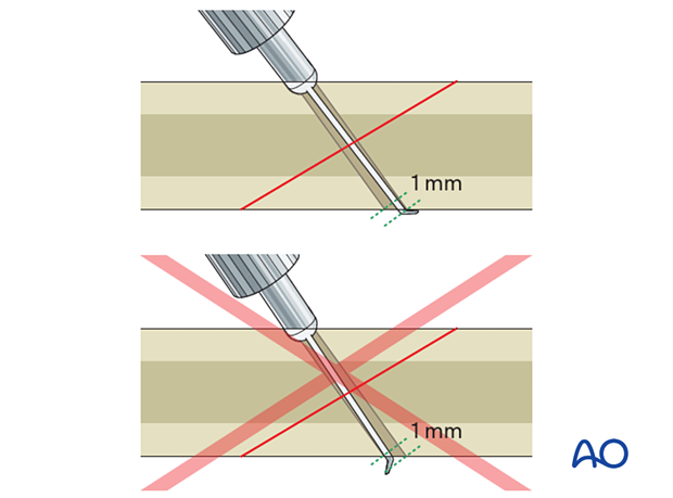 Determine screw length