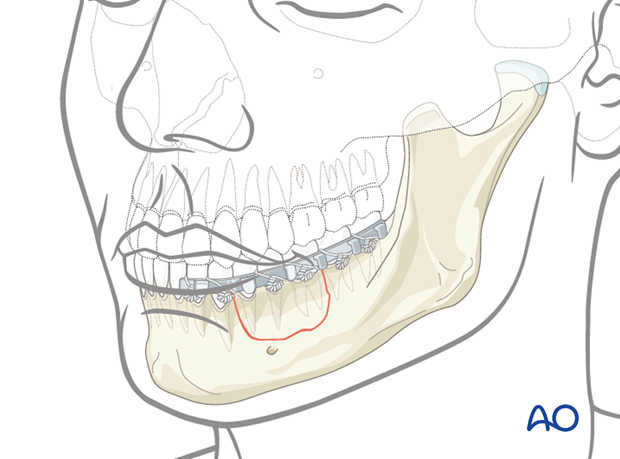 Alveolar process fractures can usually be treated by reduction and fixation with an arch bar that must be maintained for approximately six weeks to provide time for the fracture to heal.