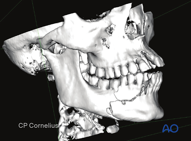 The fracture of the alveolar process reaching from the canine to the first molar is visible on this 3D CT.