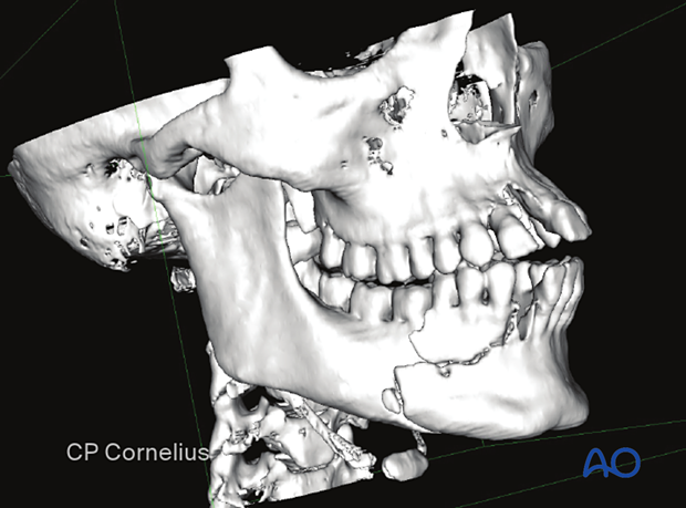 alveolar ridge skull