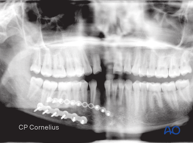 In this case, it was possible to include the alveolar fragment using a miniplate plate fixed with monocortically inserted screws located adjacent to the tooth apices.