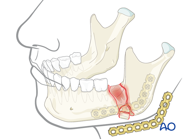 Clinical photograph showing the swelling in the mandibu