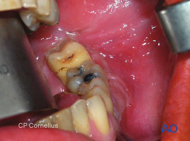 Clinical photograph showing an infected fracture between the first and second molar. 