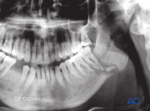 OPG confirms the clinical diagnosis of an infected fracture site in the posterior mandibular body with radiolucency around the second molar and an extended fracture zone containing several bone sequestra.