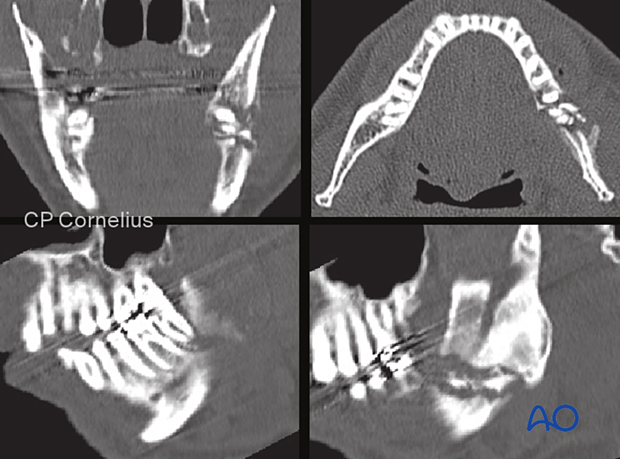 These CT scans of the same patient show the details of the fracture zone. 