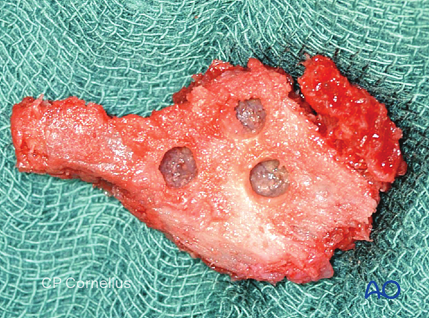 Corticocancellous bone graft before insertion