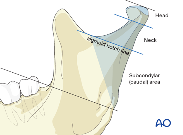 Fractures of the condylar process and head