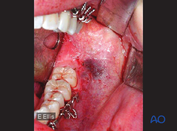 Intraoral hematoma