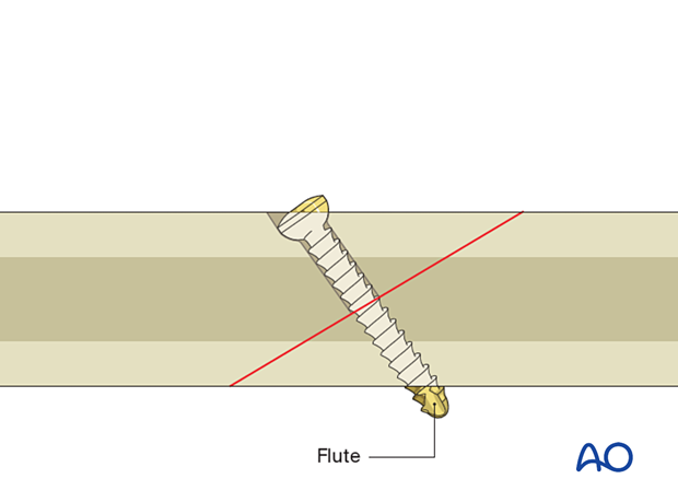Lag screw technique: when using a self-tapping screw, the flute should lie outside of the screw hole when the screw is tightened, requiring a slightly longer screw.