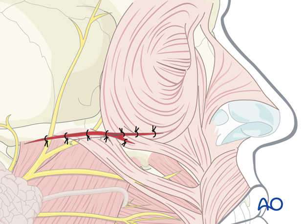 Wound closure