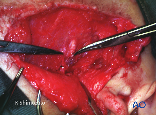 use of existing lacerations