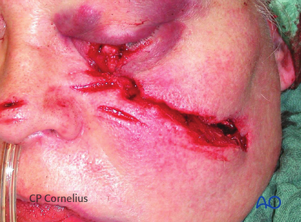 Soft-tissue laceration after a chain saw injury