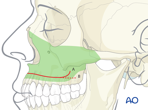 buccal sulcus approach