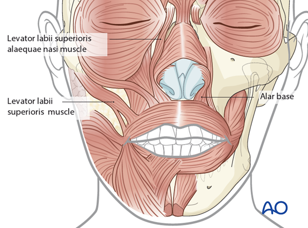Maxillary vestibular approach