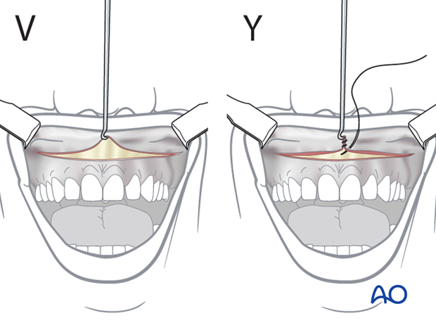 Maxillary vestibular approach
