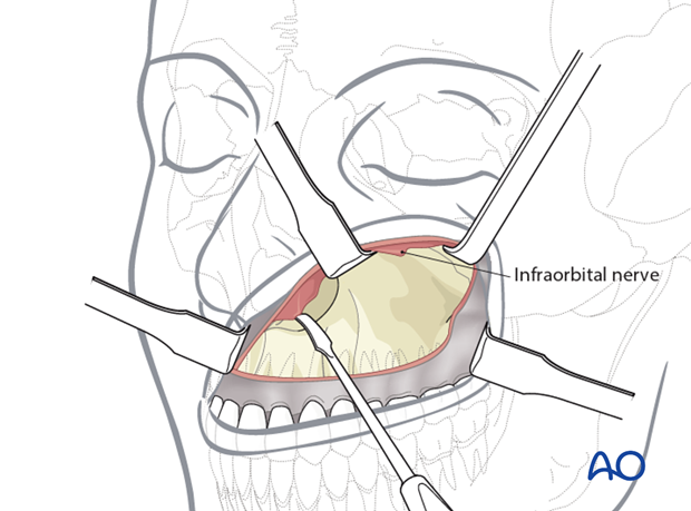 Approaches to the maxilla