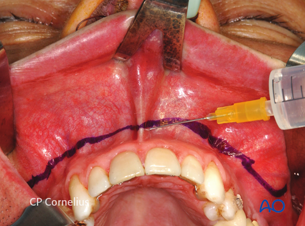 Maxillary vestibular approach