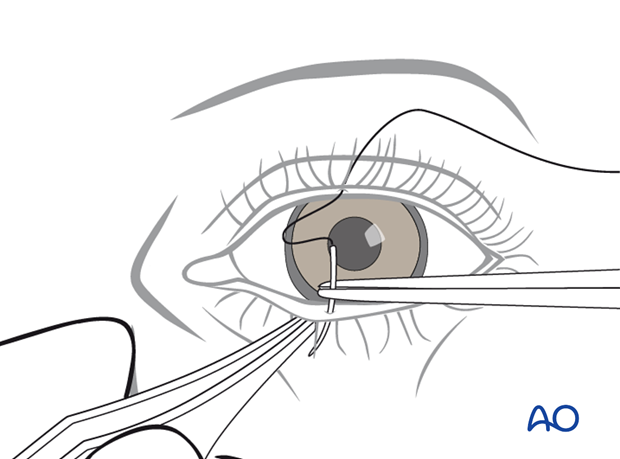 Transcutaneous lower-eyelid approach