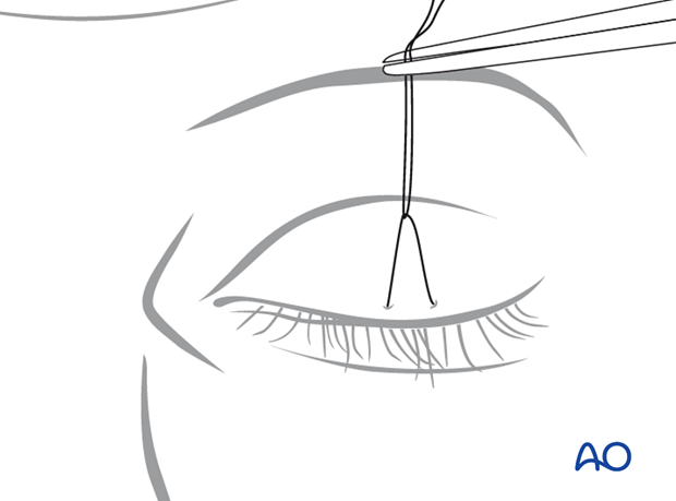 Transcutaneous lower-eyelid approach
