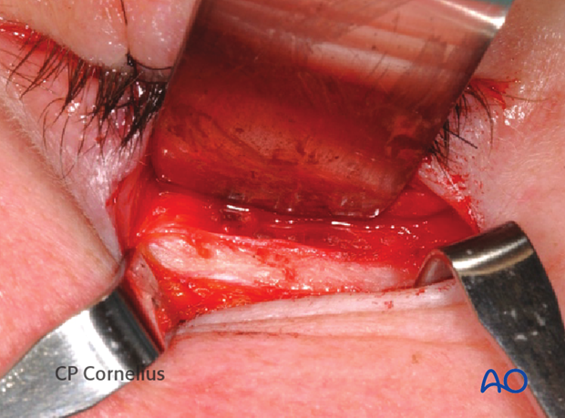 Subtarsal approach