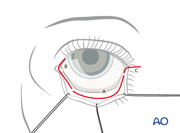 Transconjunctival lower-eyelid approaches