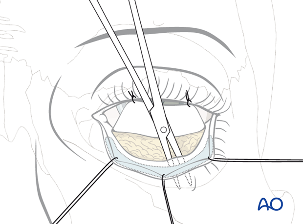 Inferior fornix transconjunctival 