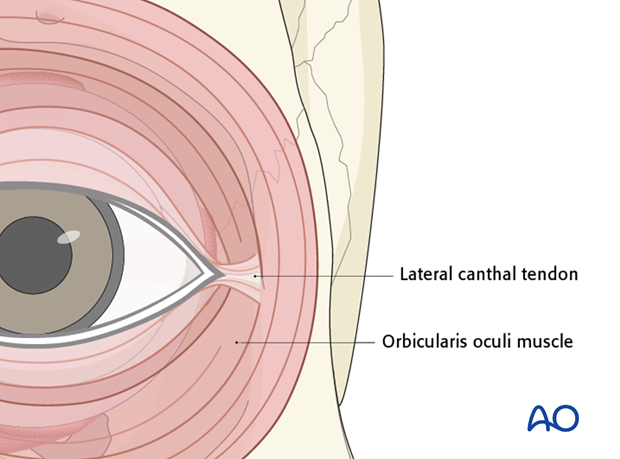 Transconjunctival approach with lateral skin extension