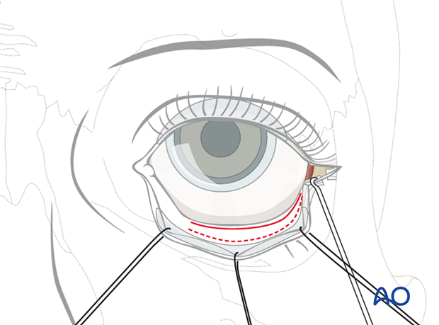 Transconjunctival approach with lateral skin extension