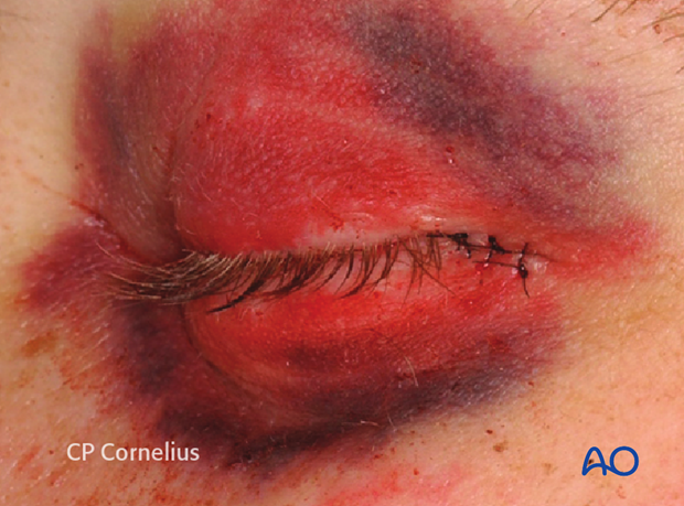 Transconjunctival approach with lateral skin extension