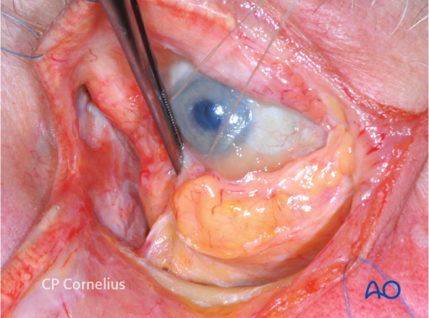 Combination of inferior and medial transconjunctival