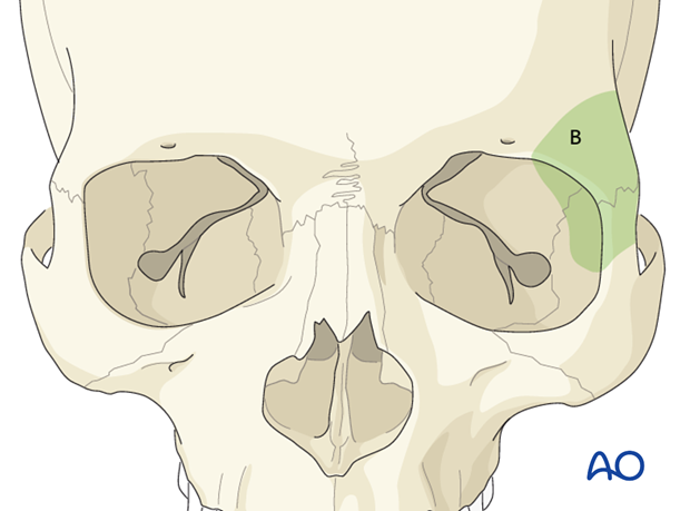 Approaches to the superolateral orbital rim