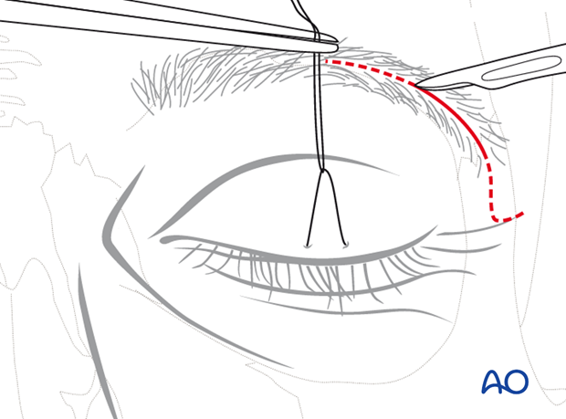 Lateral eyebrow approach