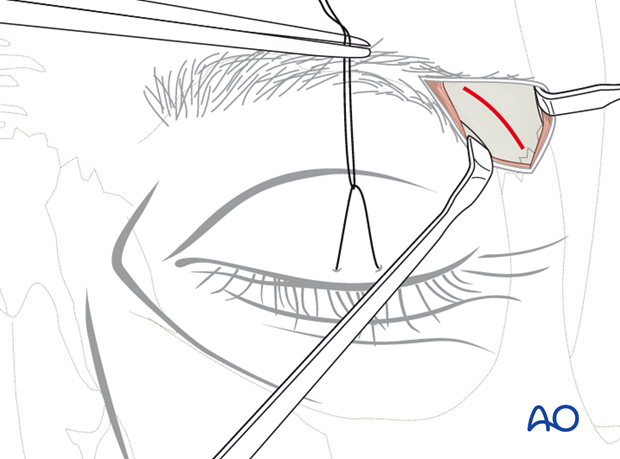 Lateral eyebrow approach