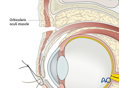 Upper-eyelid approach