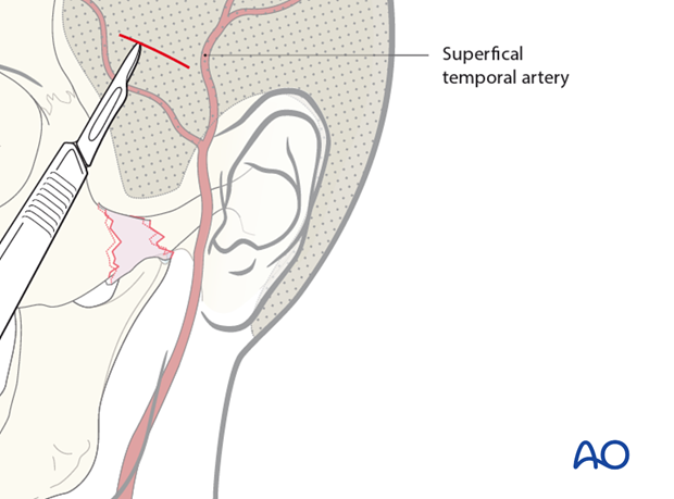indirect approaches to the zygomatic arch temporal and transoral approaches
