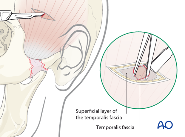 Indirect approaches to the zygomatic arch