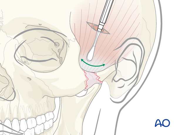 Created tunnel to pass an instrument superficial to the temporalis muscle