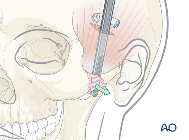 Inserted instrument to elevate the zygomatic arch 