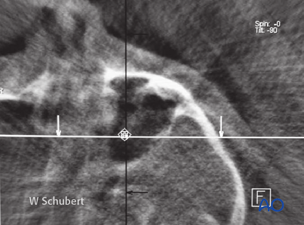 After reduction of a isolated zygomatic arch fracture reduced via the transoral (Keen) approach