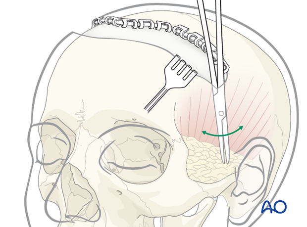 Temporal extension of the skin incision line