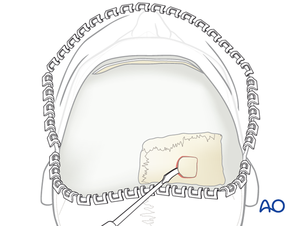 Harvesting cranial bone grafts